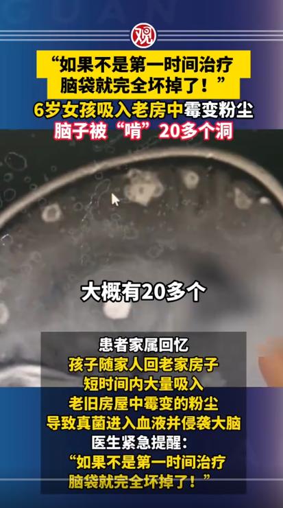 “如果不是第一时间治疗，脑袋就完全坏掉了！”，河南郑州6岁女孩，打扫老房子灰尘，