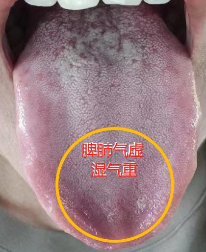 阳虚的前兆是气虚，这6大关键信号一定要早知道

当气虚了，气的推动、温煦功能会变