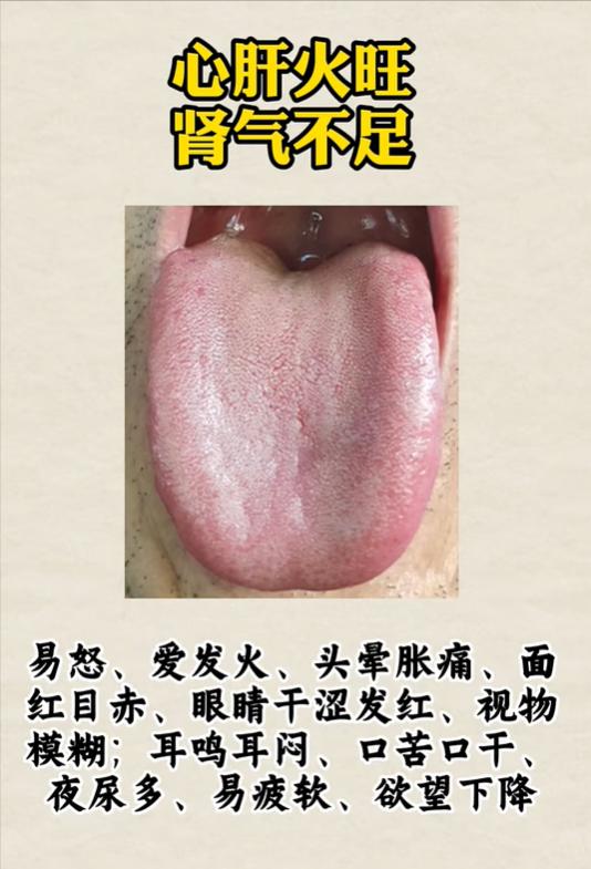 4 种常见舌象解析，教你从舌头看体质