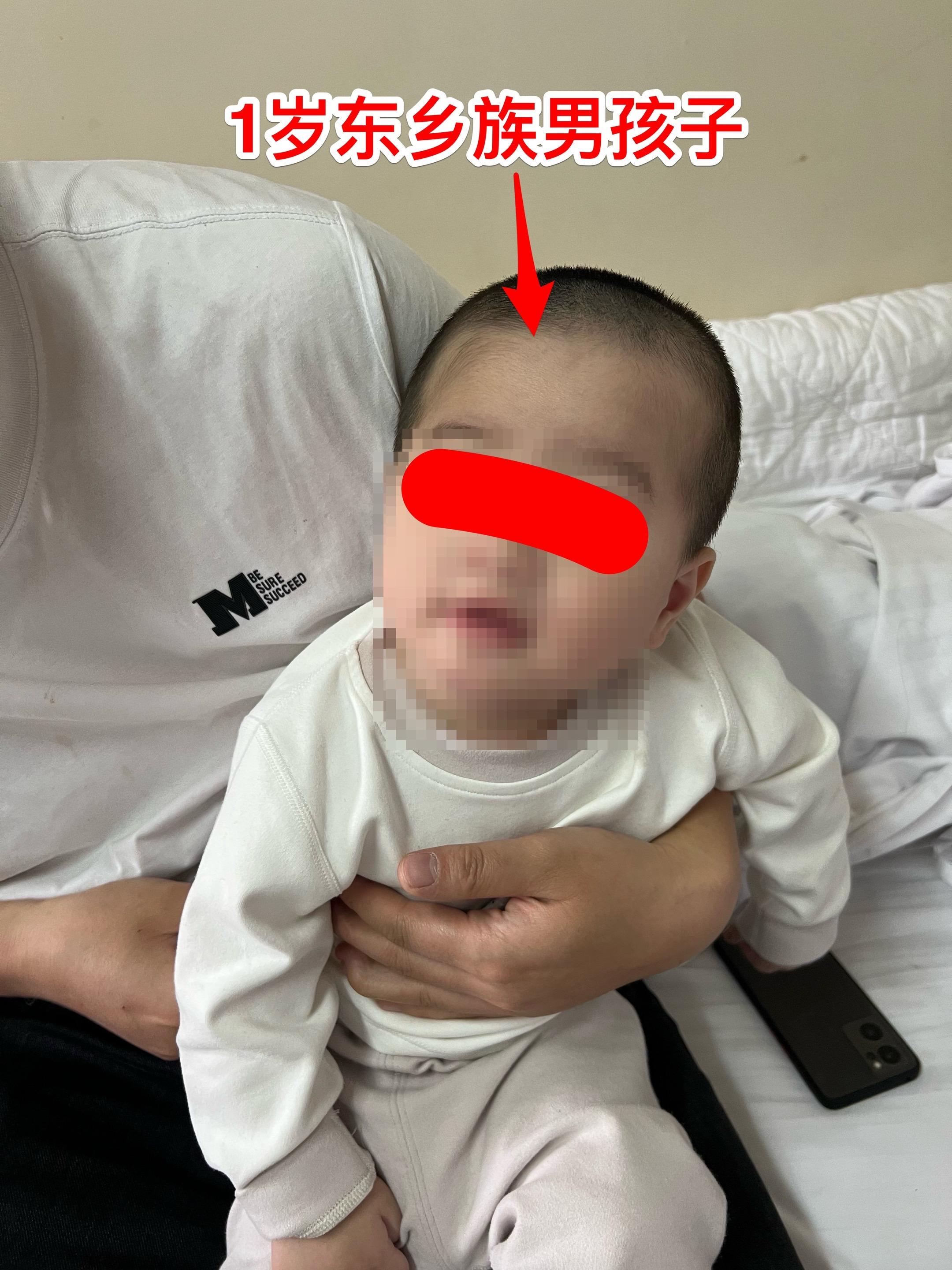 一岁东乡族男孩子面临第二次脑部手术。这个兰州的小家伙四个月前他从50厘...