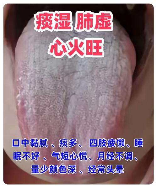 应粉丝要求，每日舌诊分析来了：

1.痰湿 肺虚 心火旺
症状：口中黏腻 、痰多