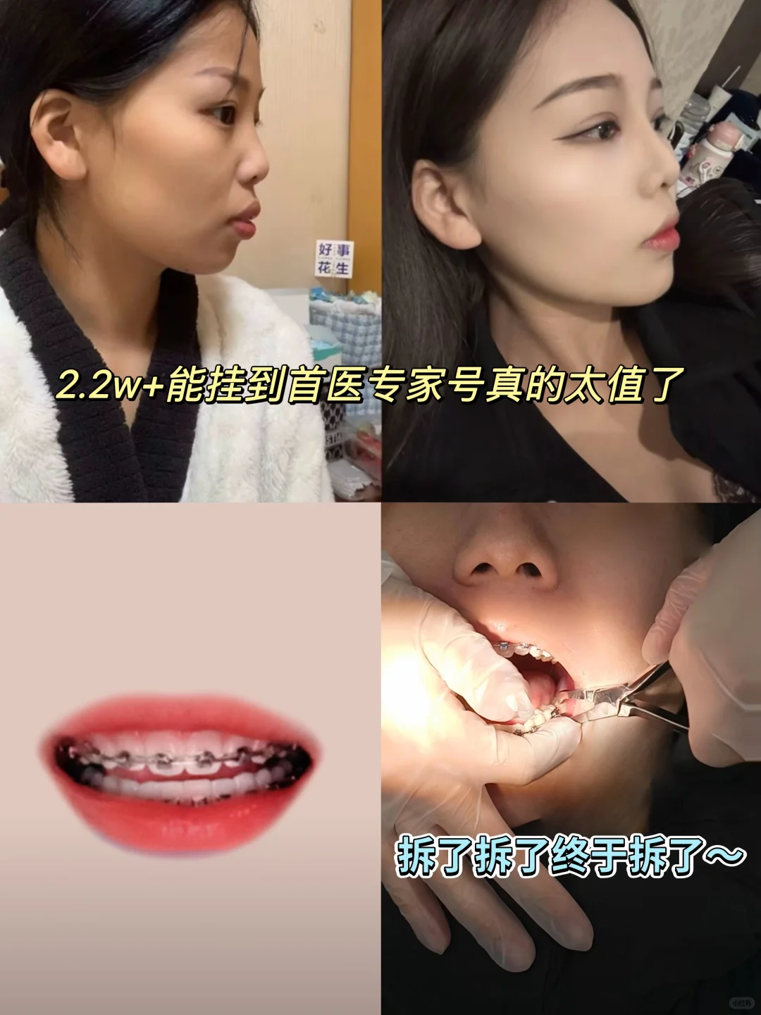 坐标北京，牙齿终于矫正完不再是钢牙妹了