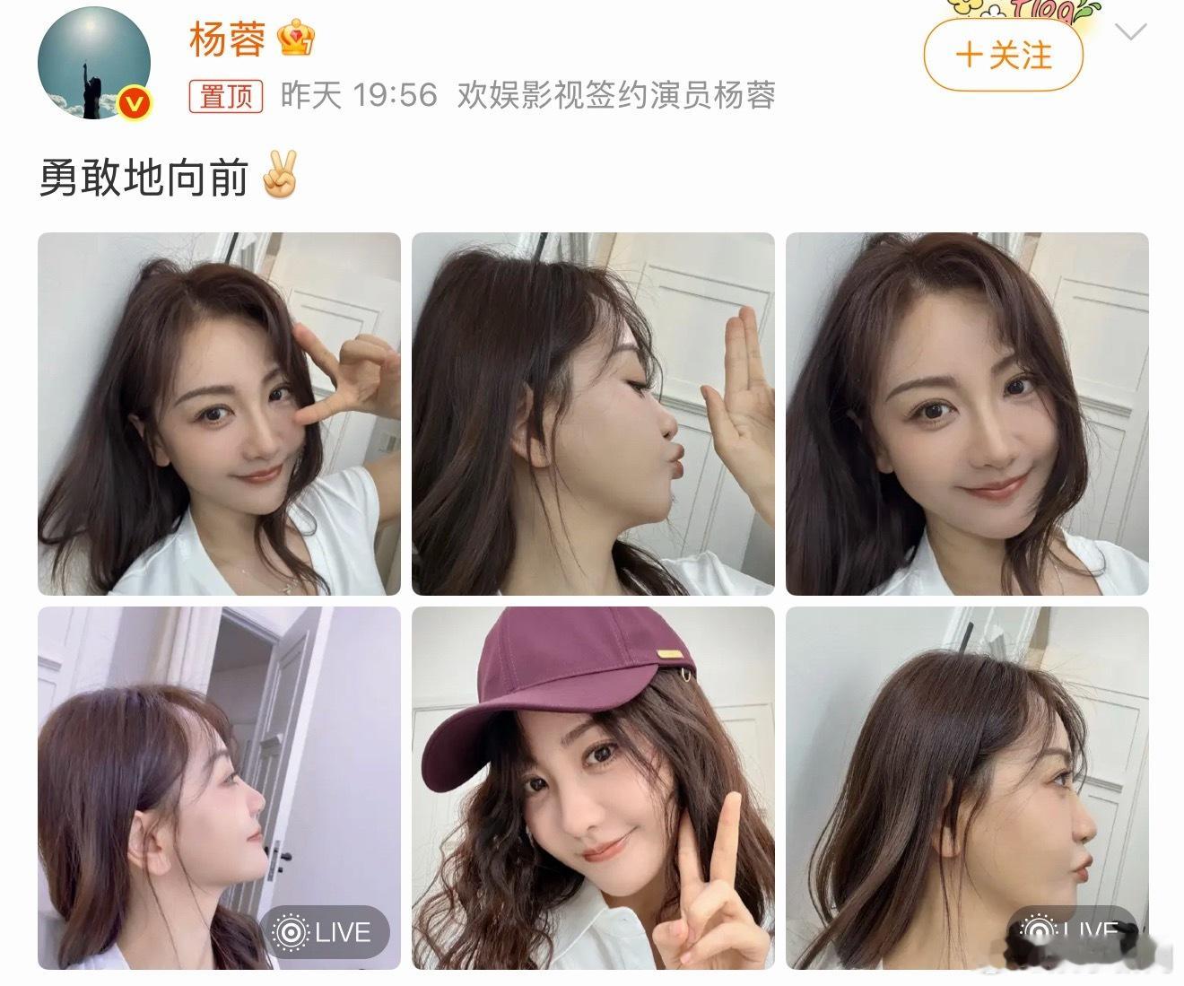 杨蓉面部烫伤恢复近照杨蓉烫伤恢复近照从意外到坦然，一周见证自愈疤痕淡去，自信愈发