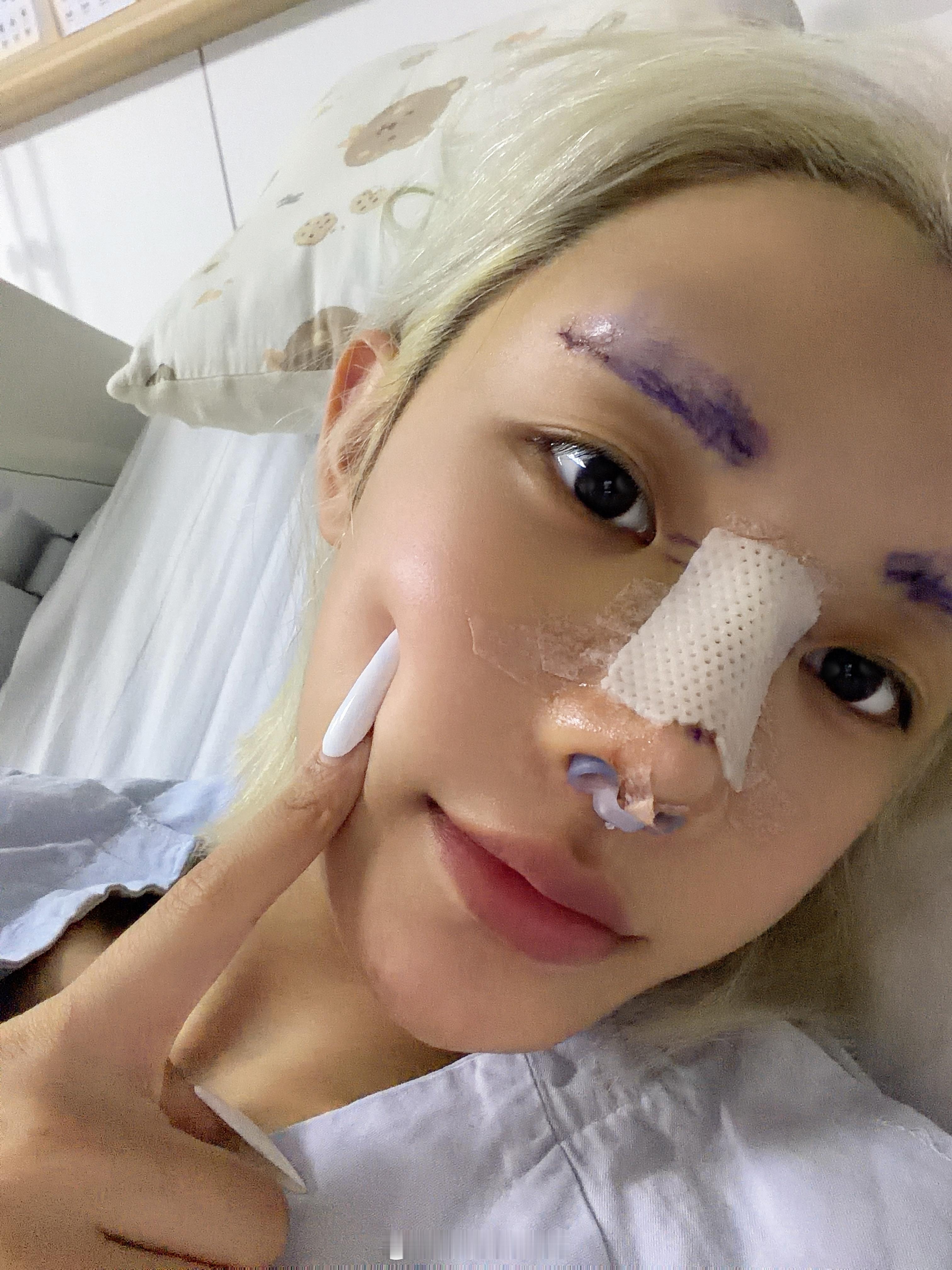5号拆线出院了 到时候给你们直播 分享哈哈哈 ​​​