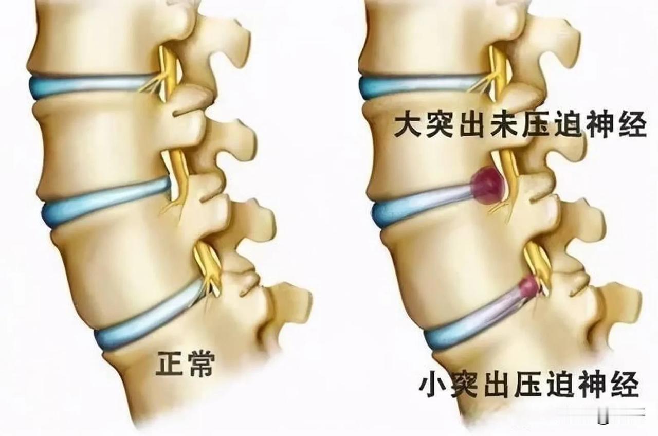 首先是保守治疗，大部分的患者通过卧床休息、物理治疗、药物治疗等保守方法，可使疼痛