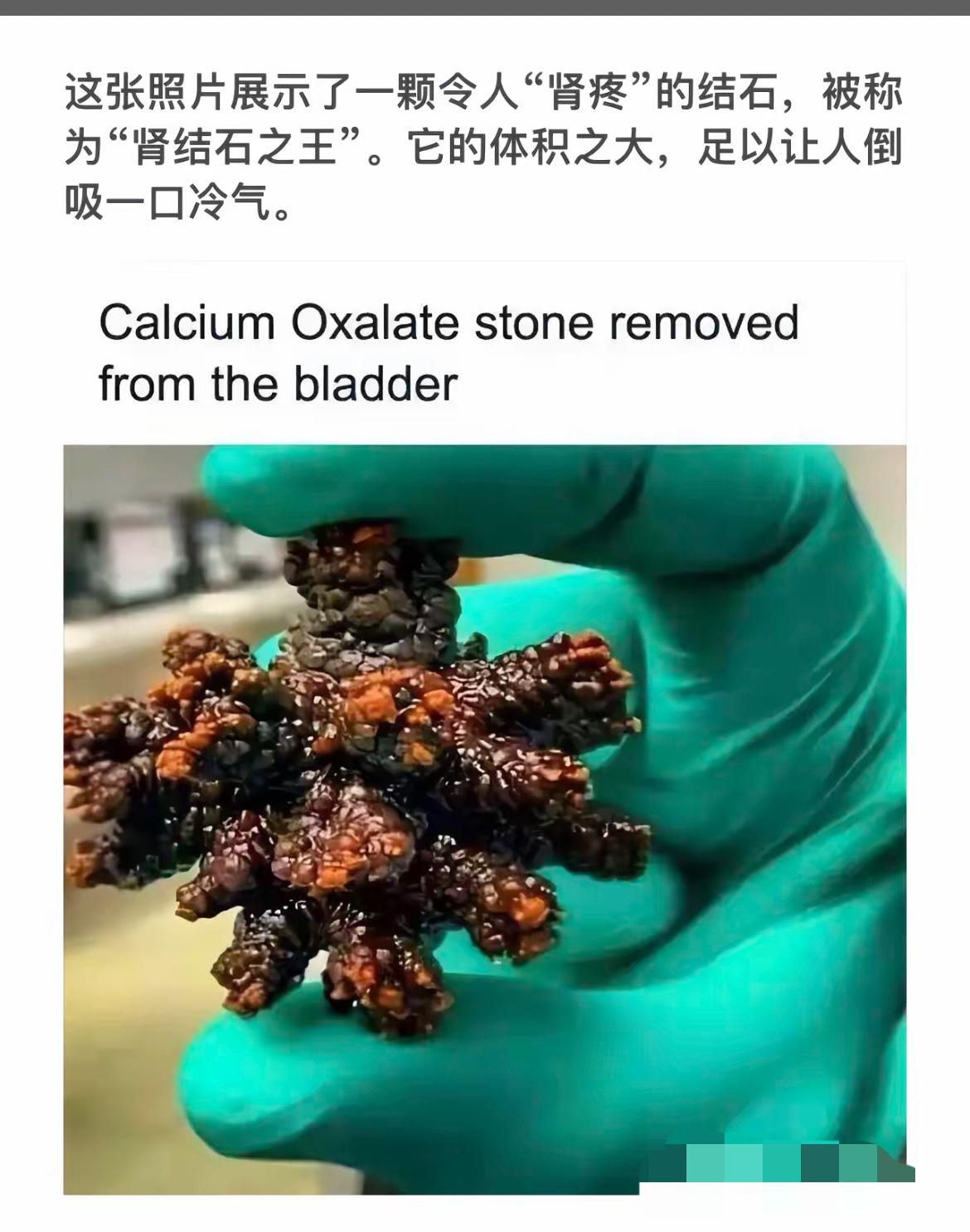 肾结石“王者”现身！医生手握巨大结石，令人倒吸一口冷气！