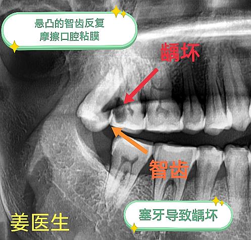 智齿的危害！智齿造成 邻牙龋坏拔除 及粘膜白斑（癌前病变）。拔掉智齿后...