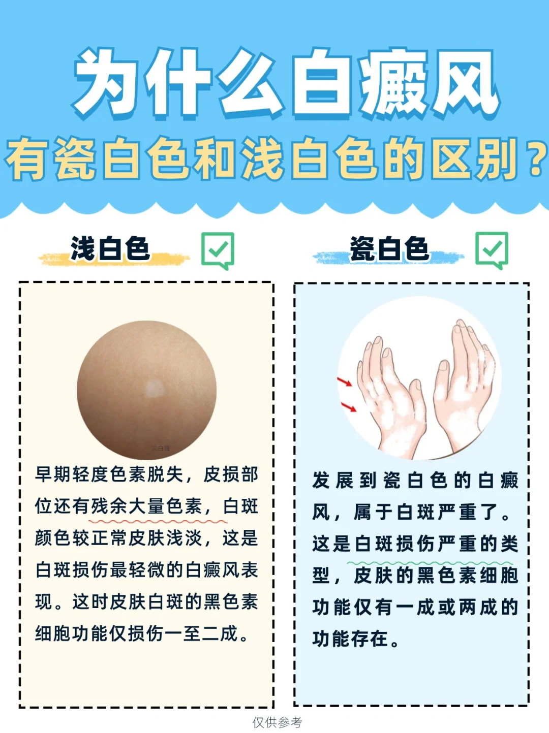 为什么白癜风有瓷白色和浅白色的区别？