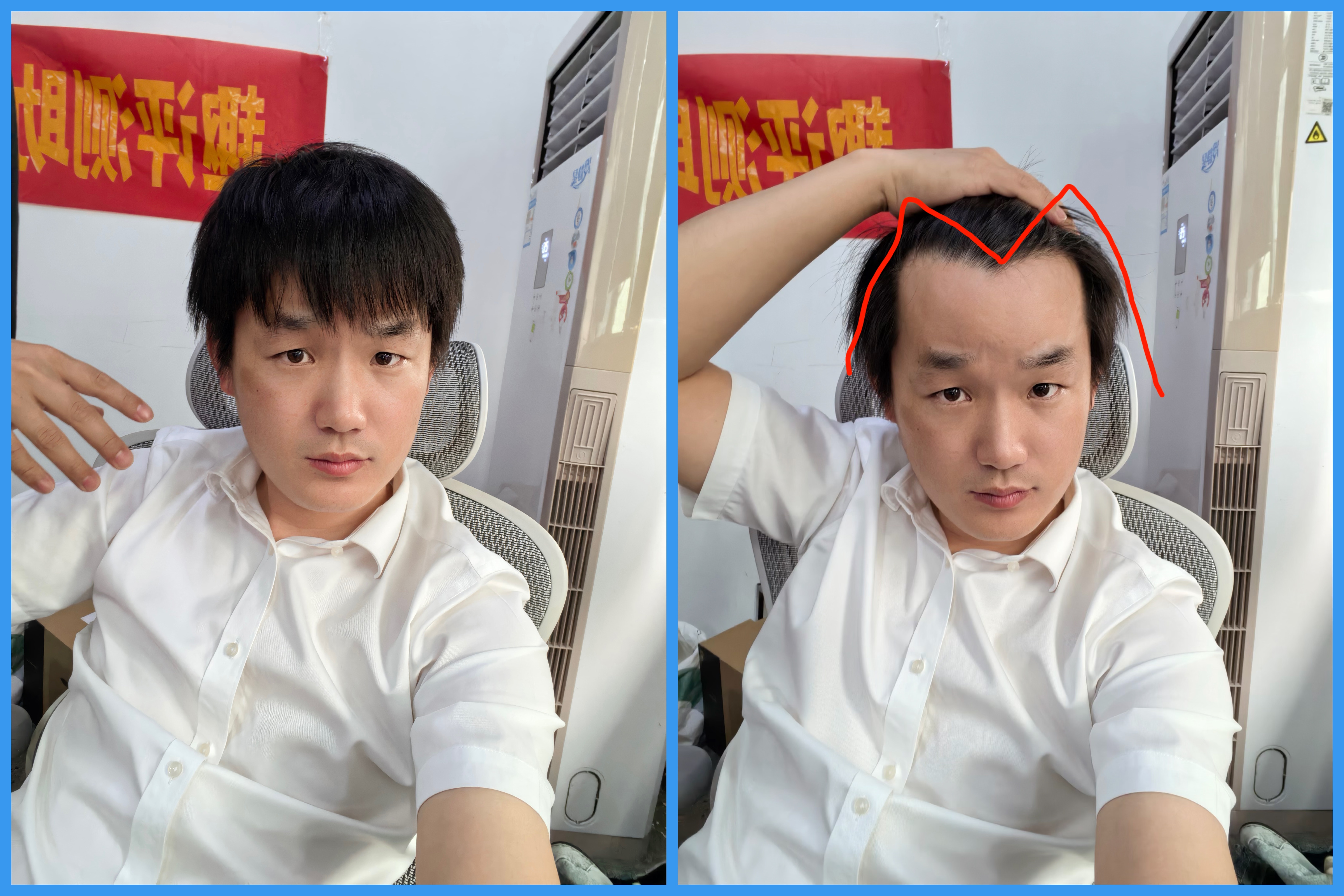 心态崩了，我以为我头发多，同事说我是“M”字母型脱发，典型的M的两个角脱发，需要