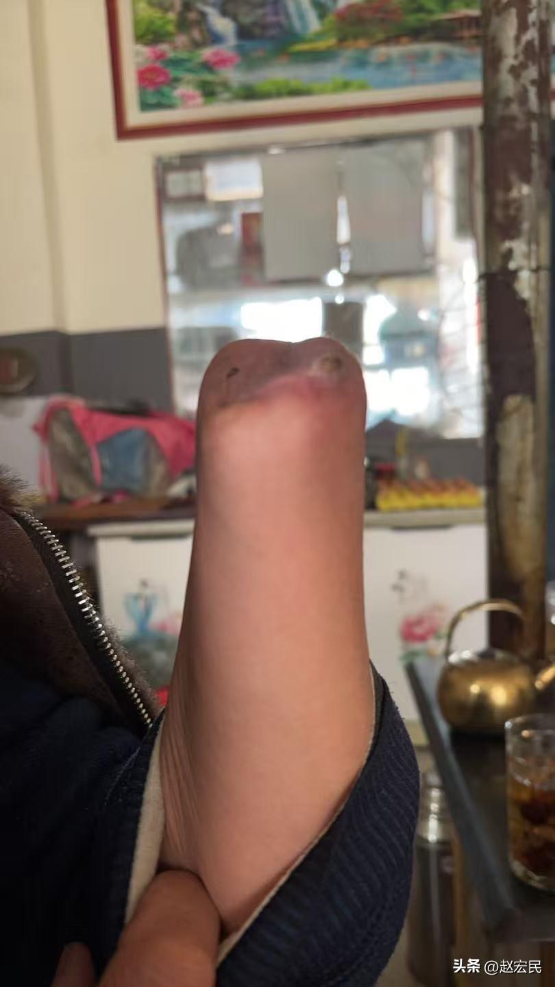 #智能假肢# 2025年12月，甘肃一位53岁的大叔，手掌卷进收玉米的机器里造成