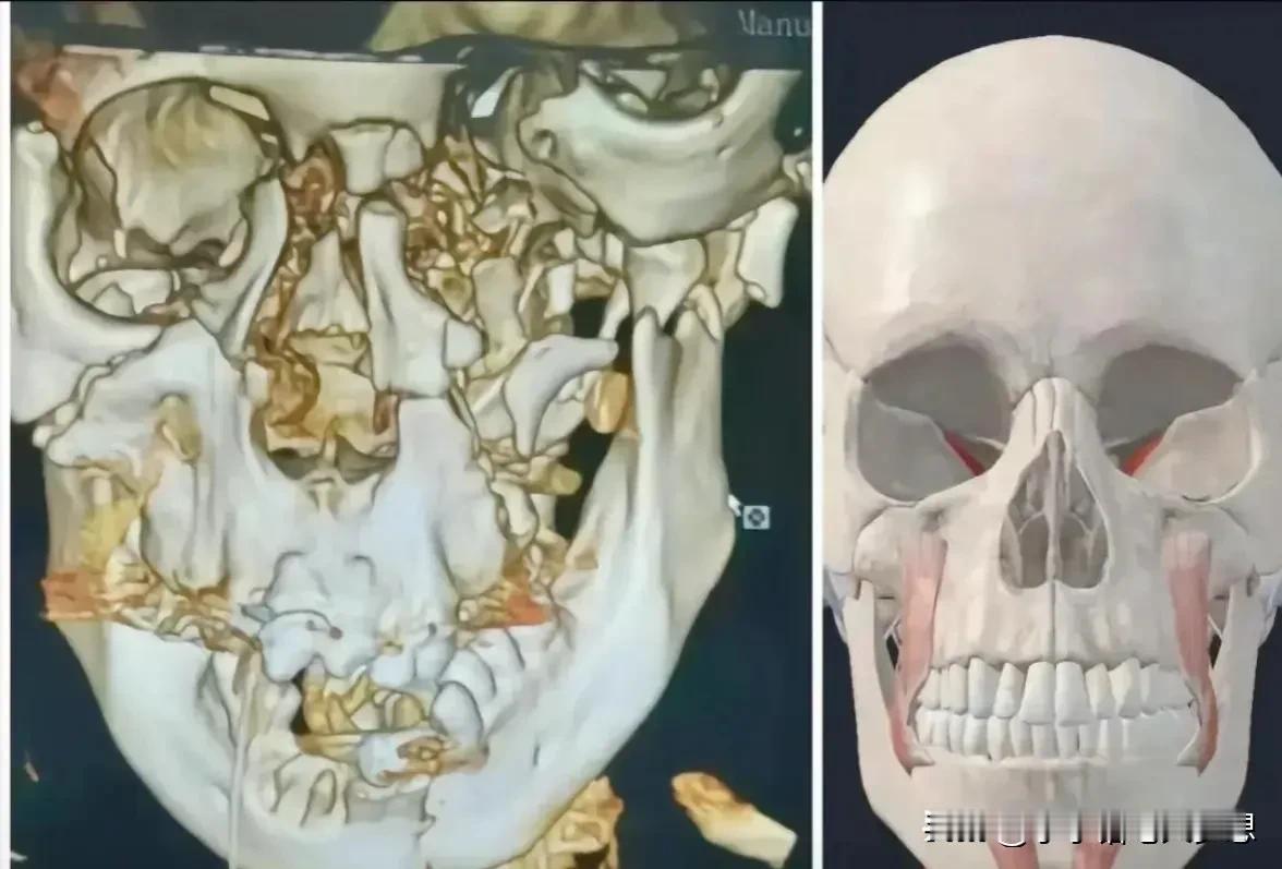 初中生被三名同学杀害案，受害者的头骨照被公布了。眼眶被打碎，鼻梁被打碎，牙齿被打