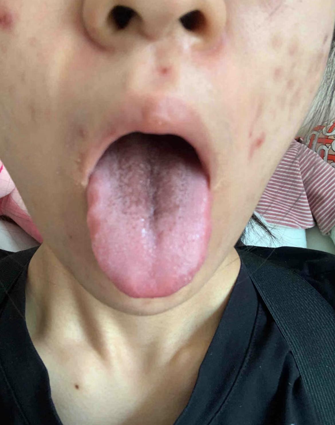 下焦淤堵的好厉害，舌根发黑，像一个坏“梨”似的
听听患者自述：快要被痘痘逼疯了[