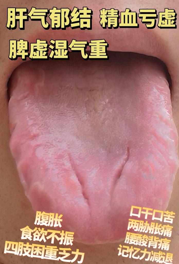 薛老师舌象分析
1.脾虚湿气重
2.脾肾两虚
3.肝气郁结