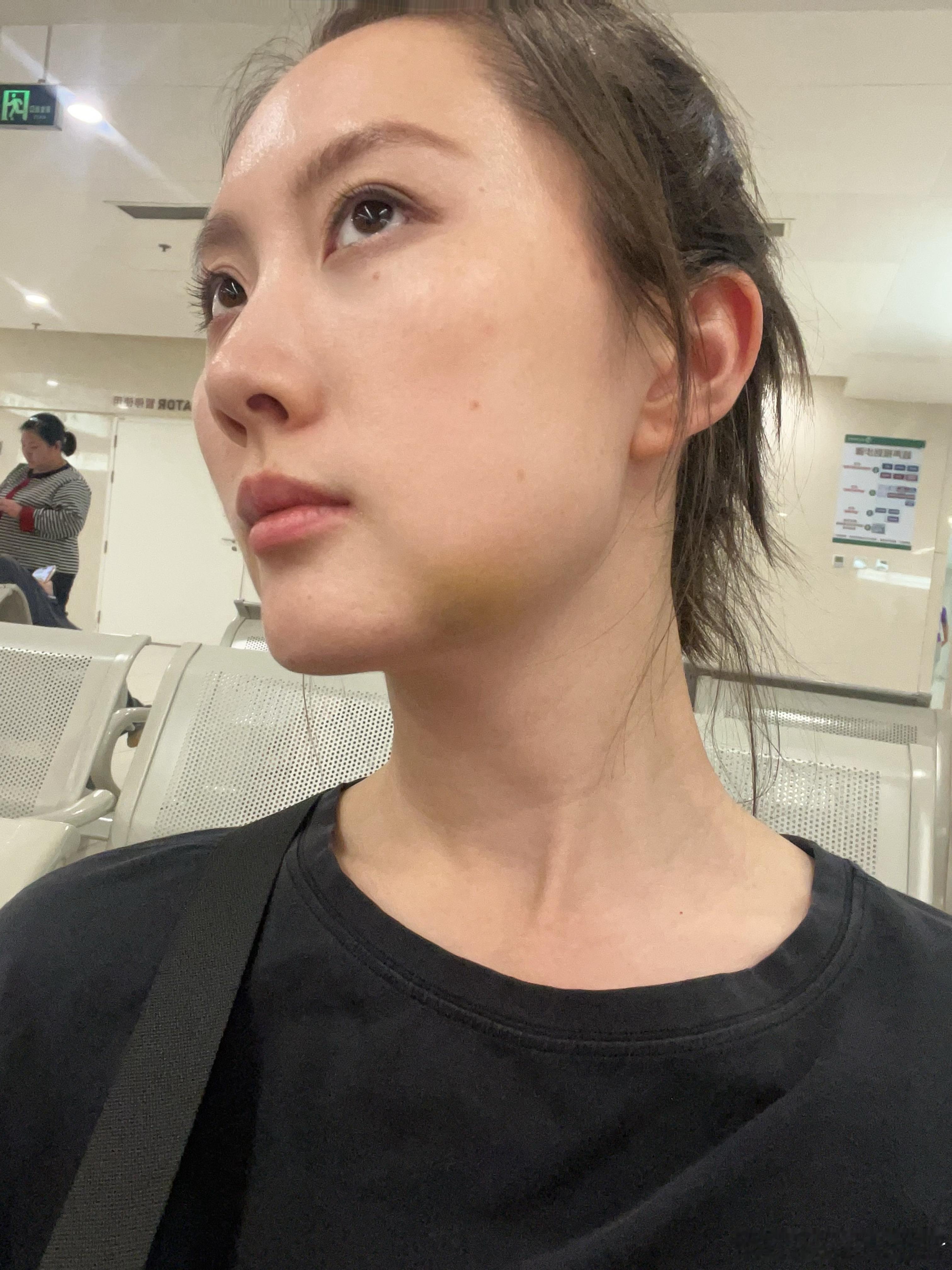 拔智齿第三天：今天没有更肿，但是变成了淤青很多人问我是不是被揍了 北京