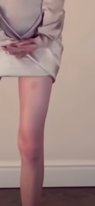 昨天机场挤的宝宝大腿被磕到淤青了🥺 ​​​