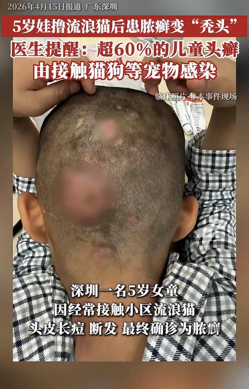 5岁娃总摸流浪猫，头皮长痘还掉头发，一查竟是脓癣!医生说超60%儿童头癣都是猫狗