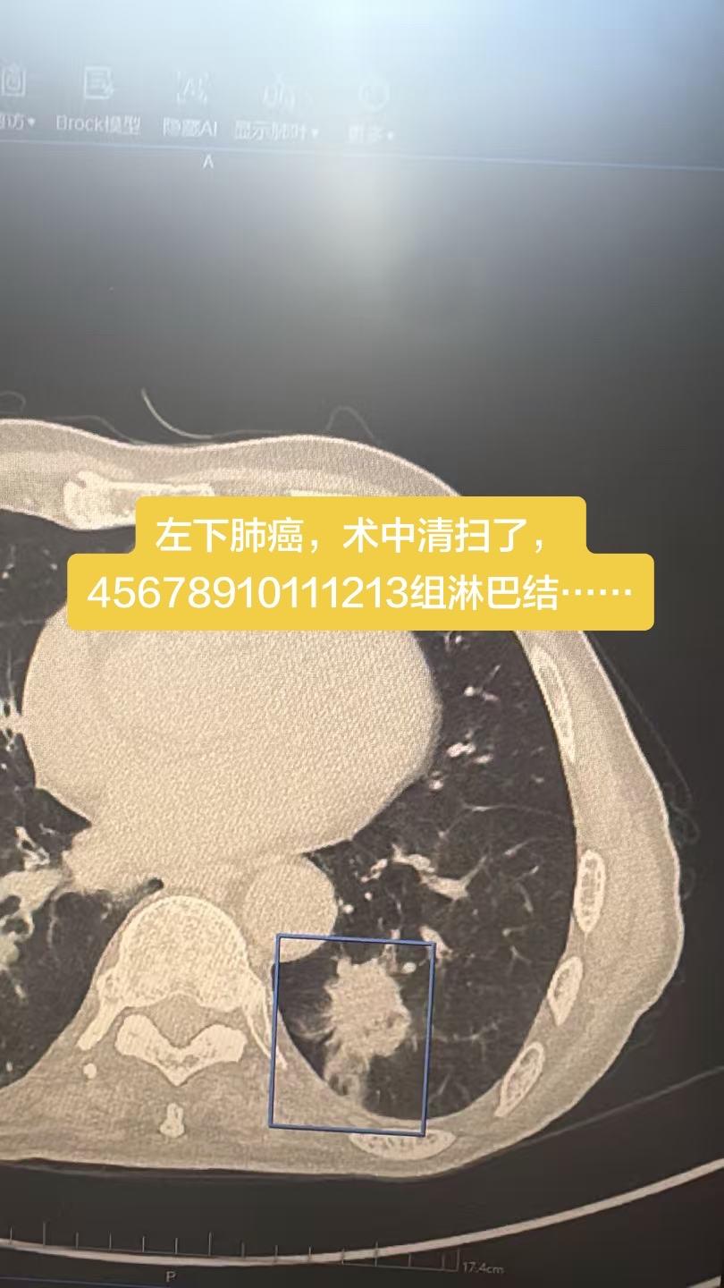 左下肺癌，术中清扫了，45678910111213组淋巴结……