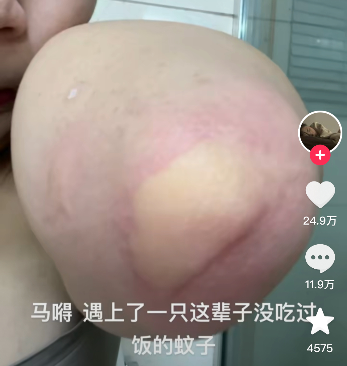 #讨厌蚊子的有力证据#让我看看你们的蚊子包 ​​​