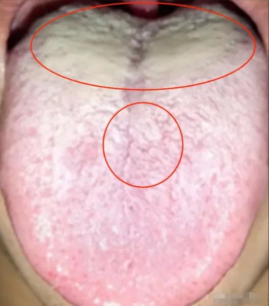 这种舌象，吃再多的桂附地黄也没用，为啥这样说？
 
我们先来看他的舌象：舌根苔厚