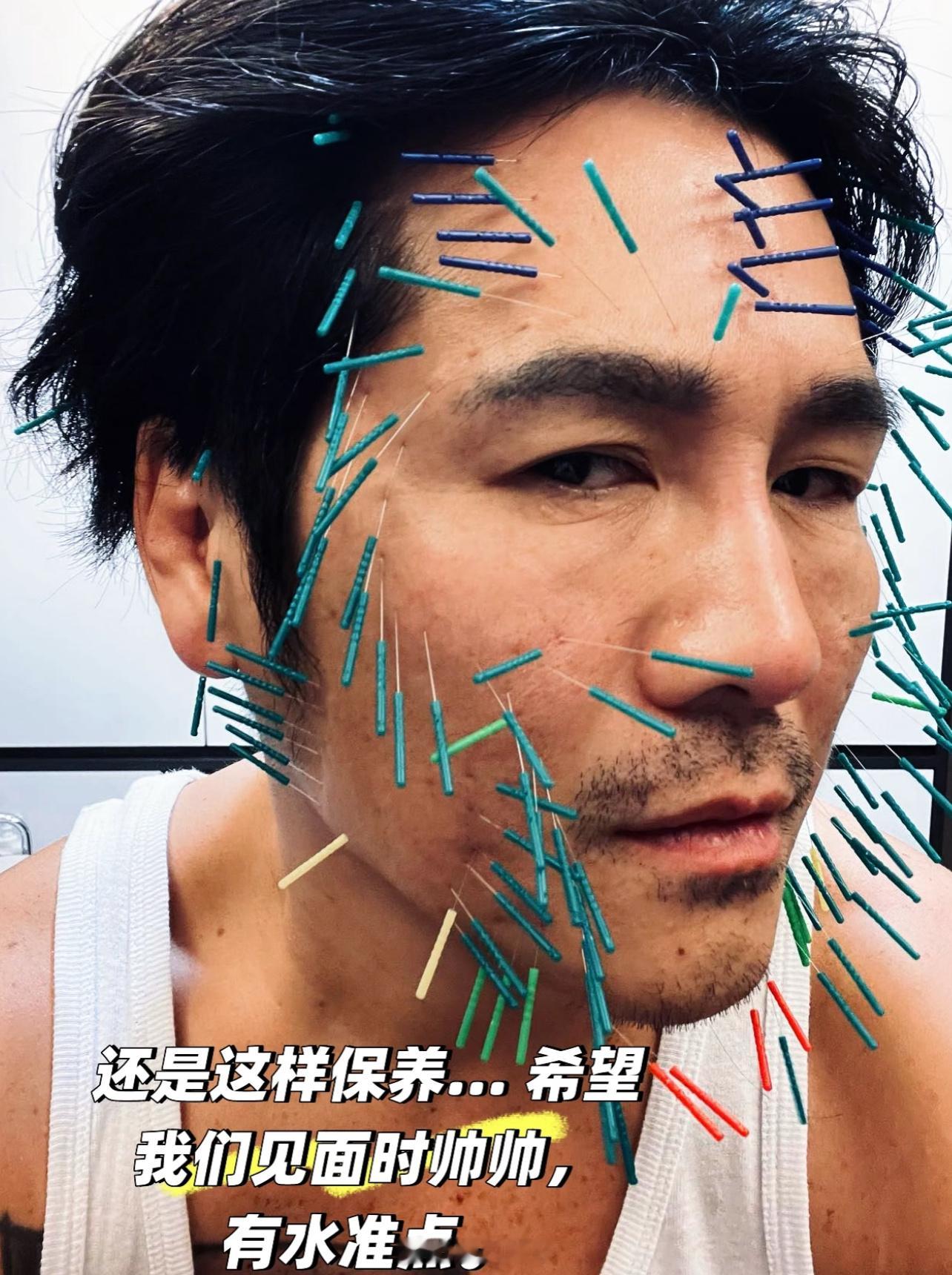 曹格针灸保养🈶️被吓到|ﾟДﾟ))) ​​​