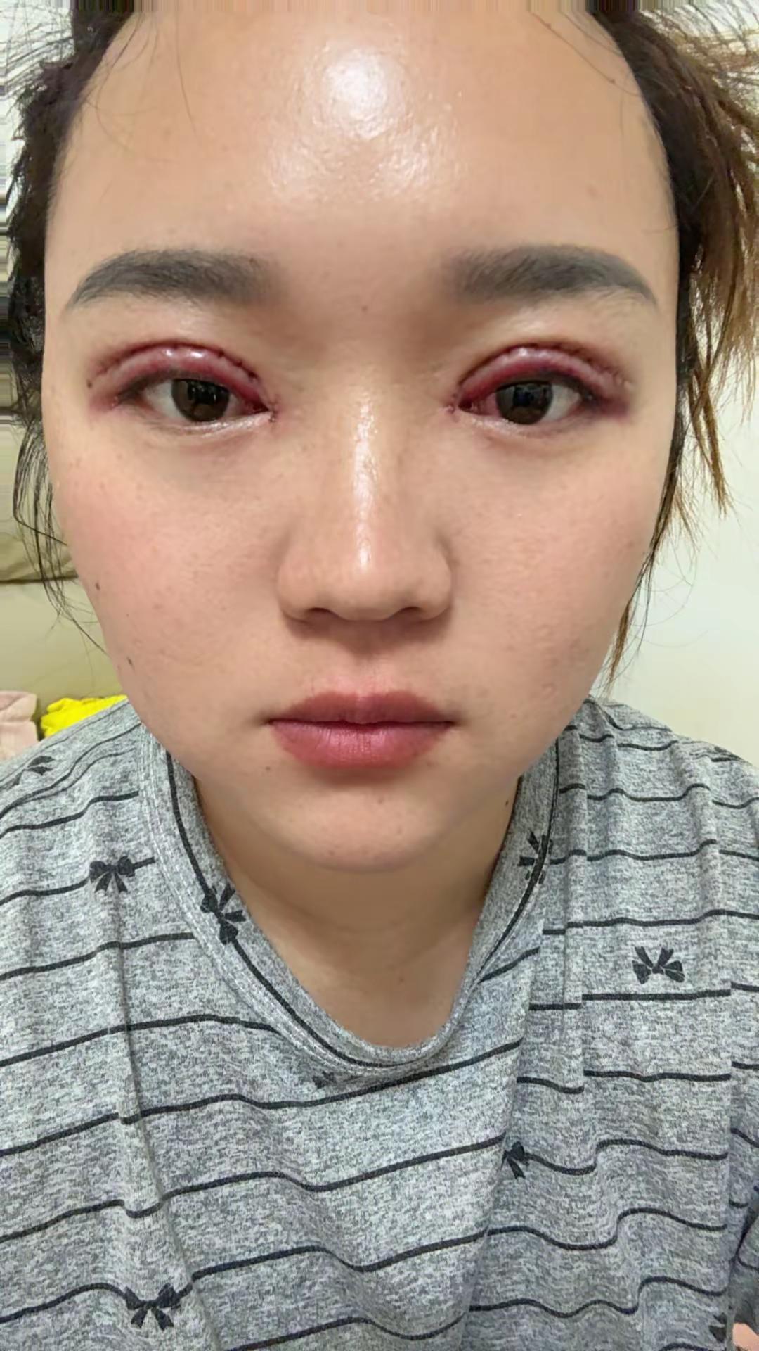 双眼皮手术第一天，双眼皮全切，去皮，去脂，开眼角，眼角提升，翘睫，眼综合六件套，