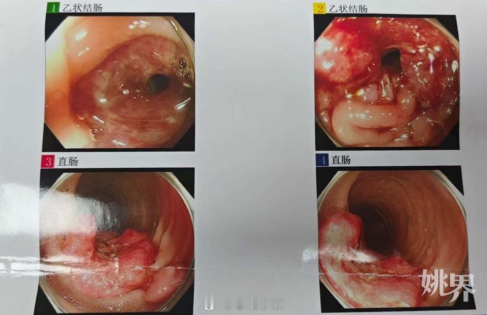 【以为是痔疮，结果竟是癌！只因未注意这个细节， 余姚男子确诊已是中晚期  】“医