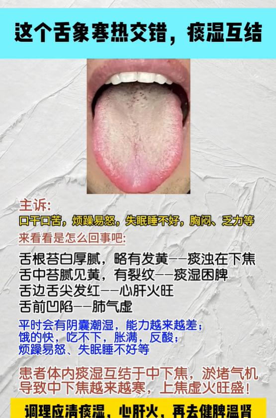 舌象显现寒热交错，体内痰湿相互郁结