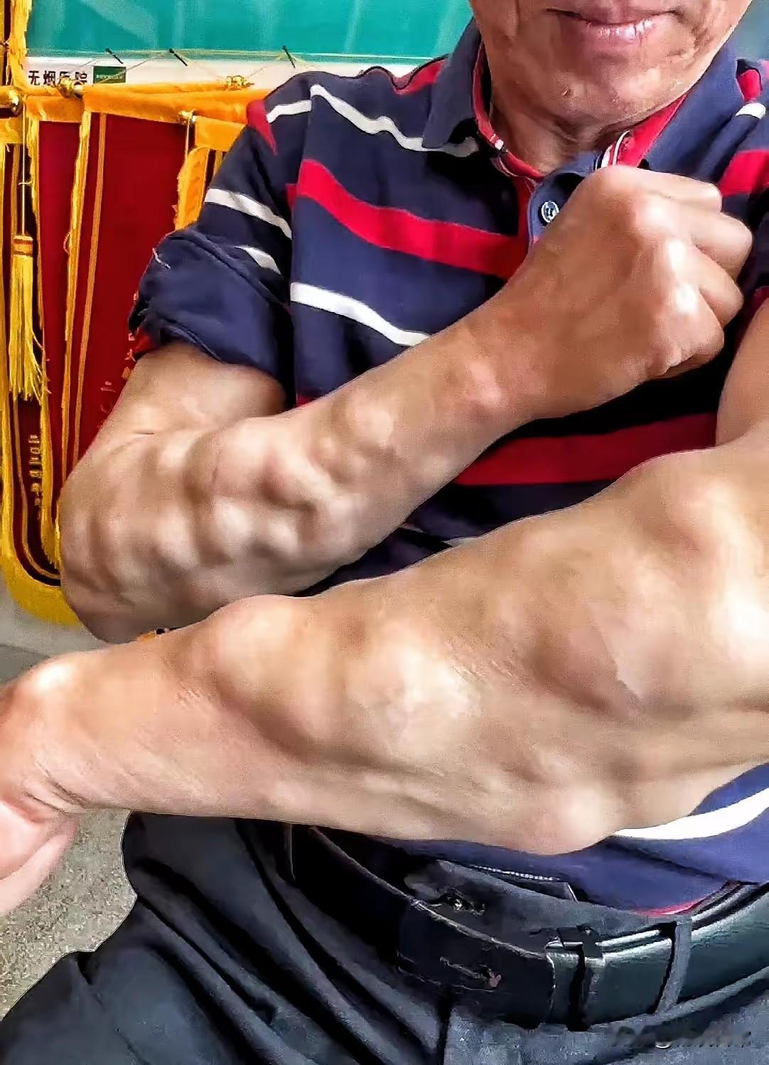 前几年去逛公园，见过一个男子的手，跟这个男子的手一样，上面长着一坨坨的东西，只不