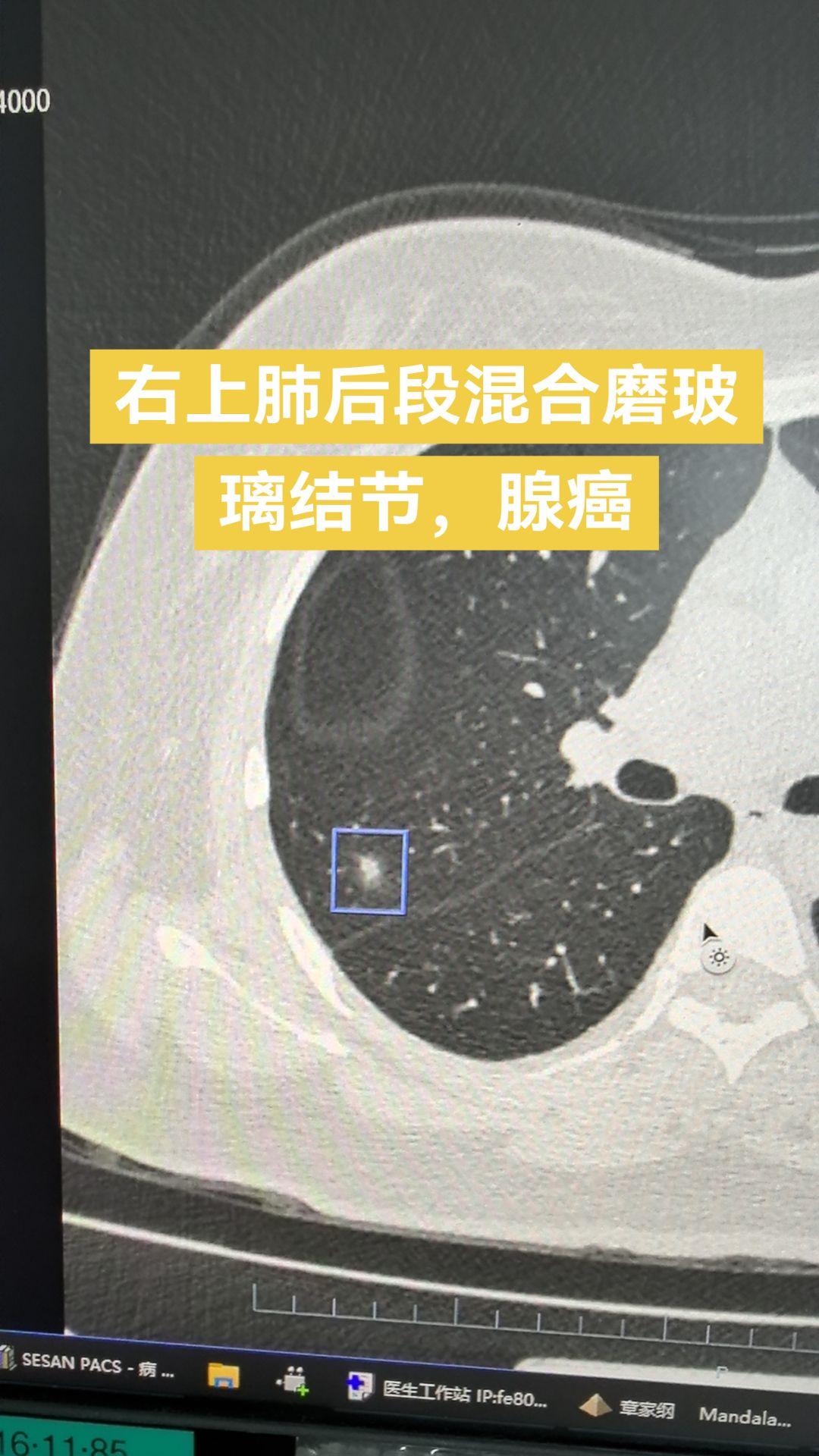 右上肺后段混合磨玻璃结节，腺癌……