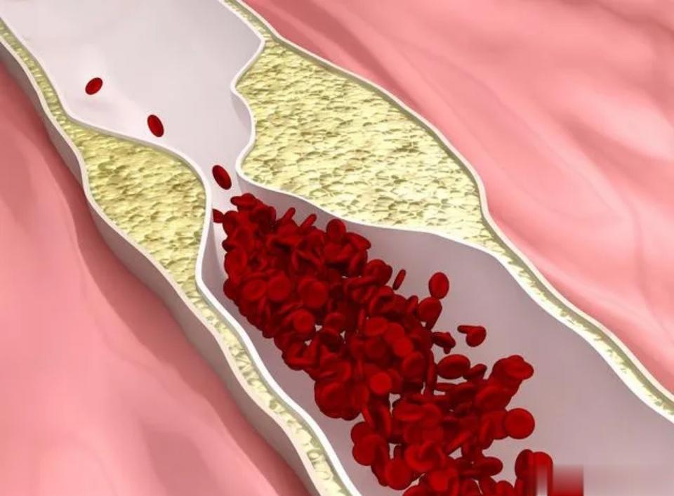 血脂可能在你不知情的情况下攀升，4个生活习惯帮你控制1、多吃粗粮、蔬菜过于精细的