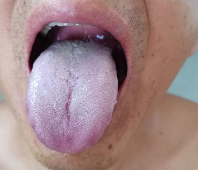 碰见这样的舌头，就不要当作阳虚去治
这个舌头不仅阳虚，更重要的是血瘀[灵光一闪]