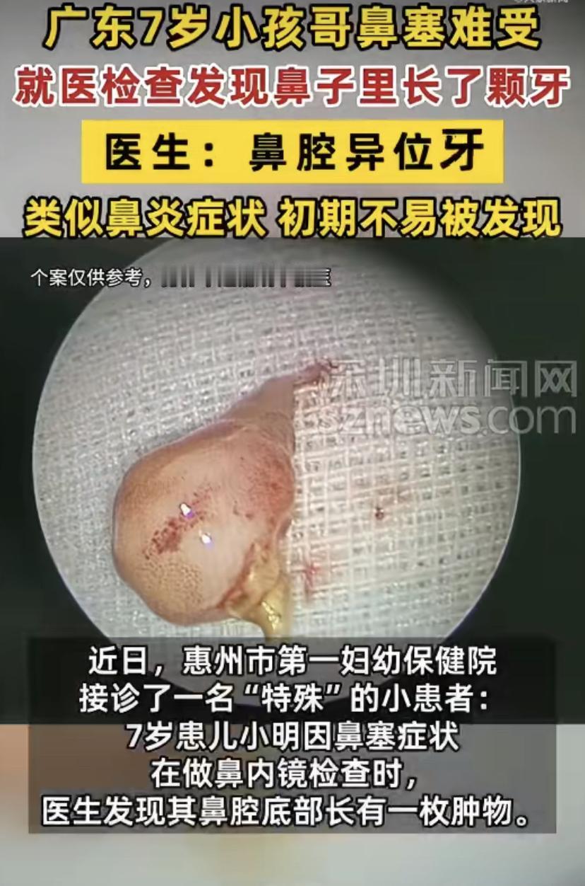 惠州7岁男孩老喊鼻子不舒服，一查吓一跳：鼻子里竟然长牙了!
最近广东惠州一个7岁