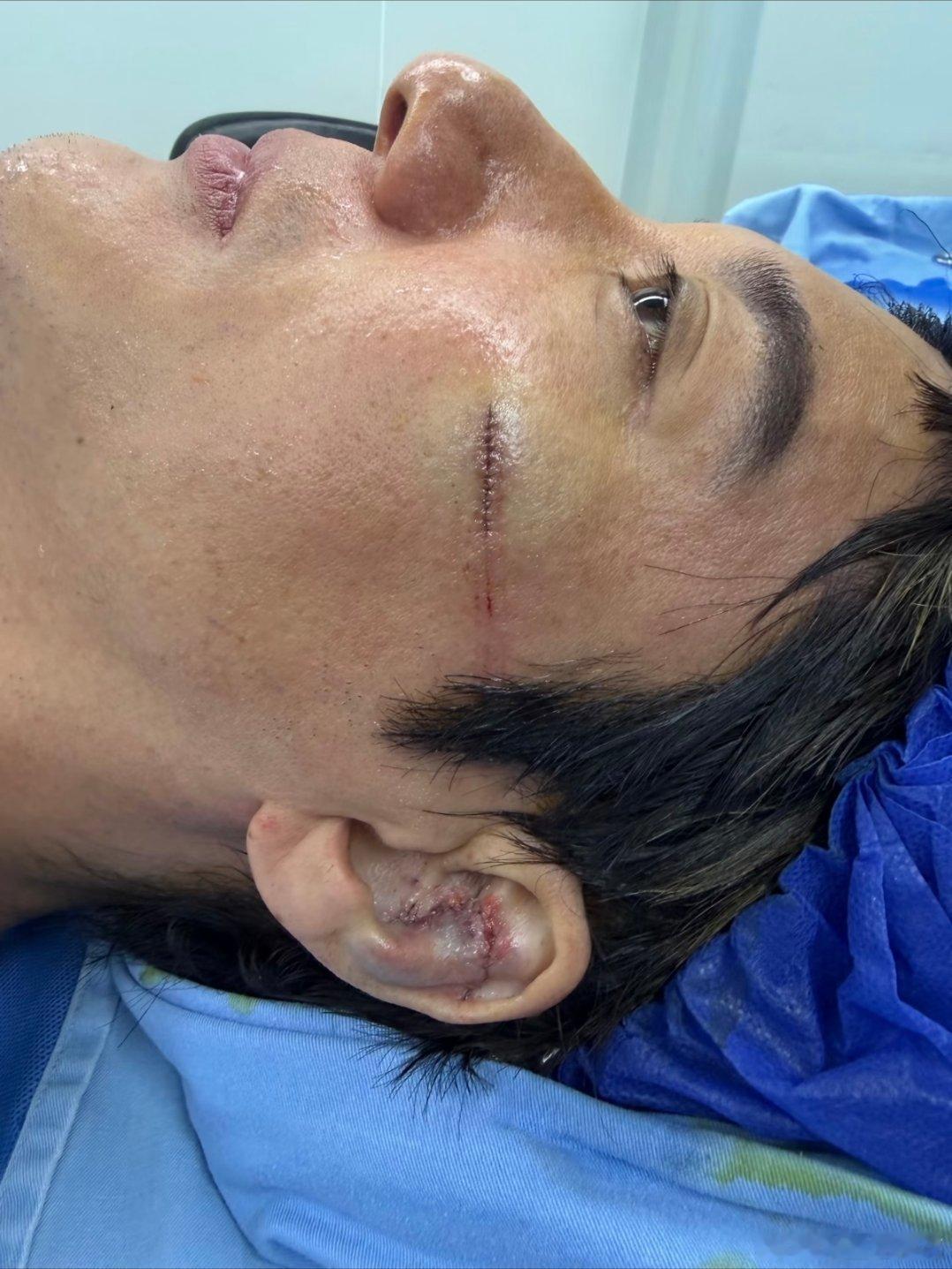 王力宏缝了39针看到好多人都说缝合的好好 我只觉得他好敬业 脸和耳朵都伤成这样了