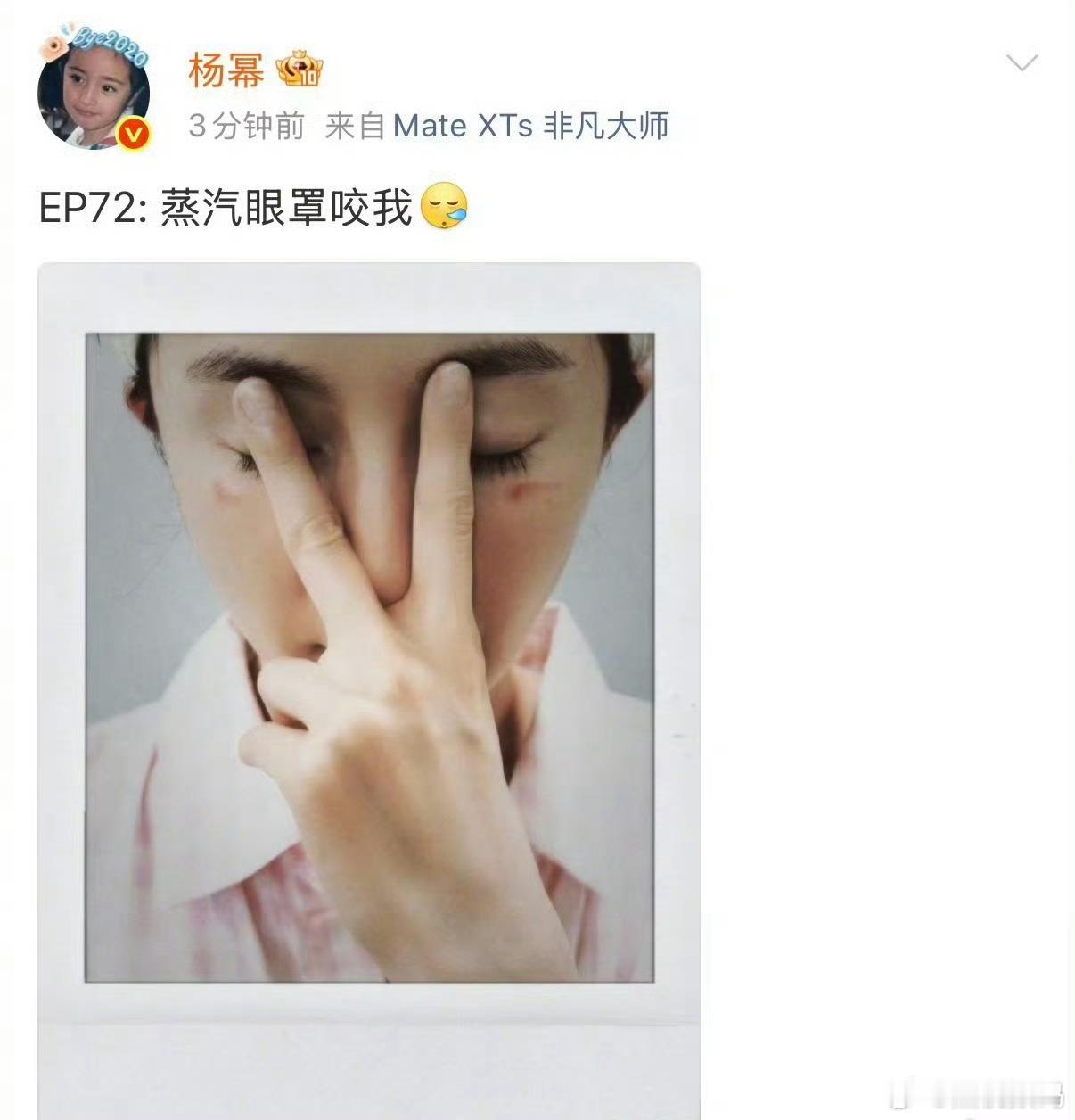 杨幂脸被蒸汽眼罩烫伤了这次蒸汽眼罩也是“上大分”了，幂姐眼睛都被烫伤了，以后选择