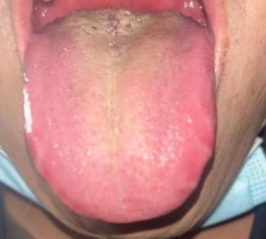 想法强，但能力跟不上，说的就是这样的舌象，男人女人见了都得发愁！ 

患者主诉：