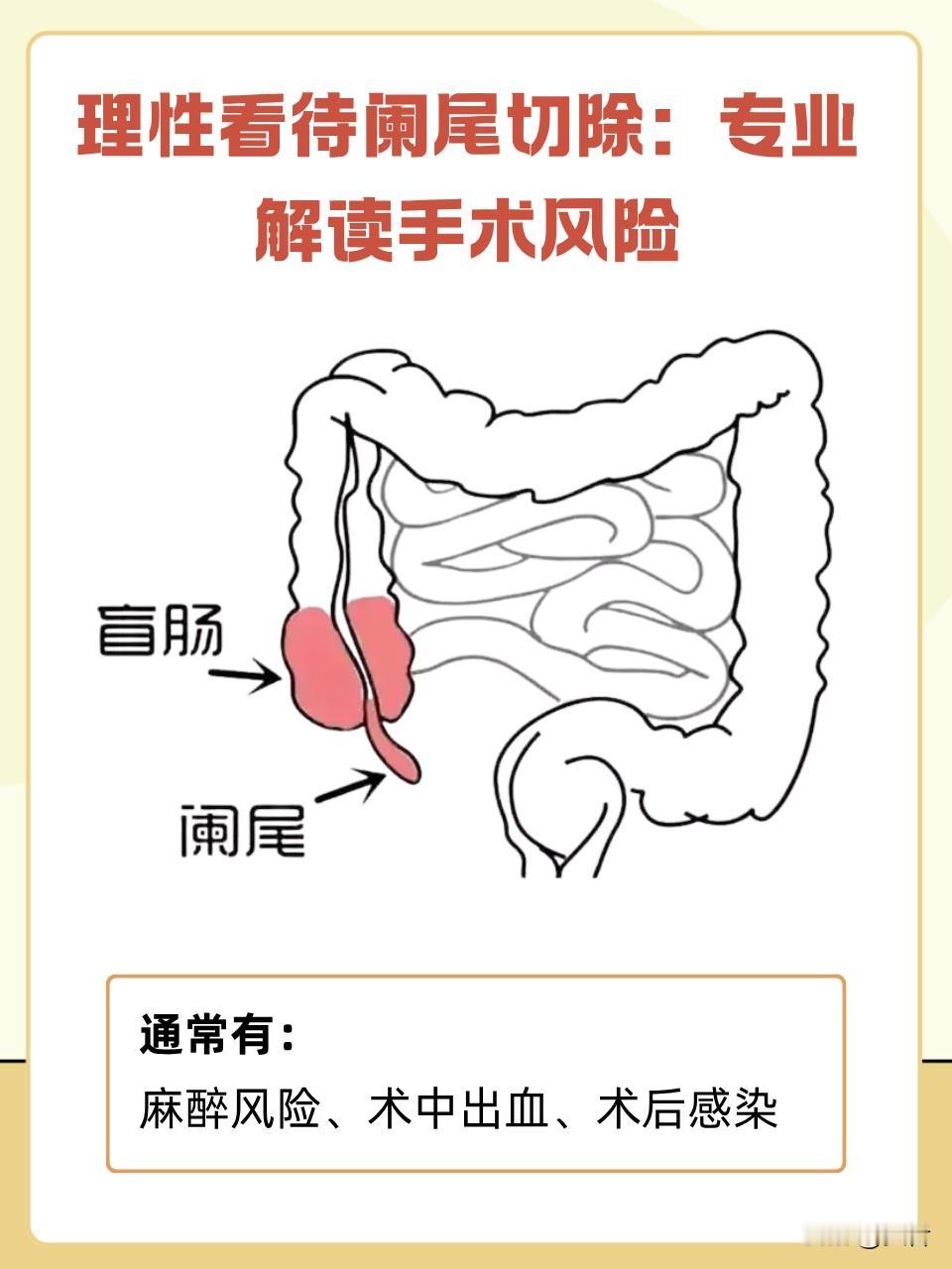 突发急性阑尾炎，两天跑两家医院反复纠结！手术还是保守，太难选了！

前天上午，我