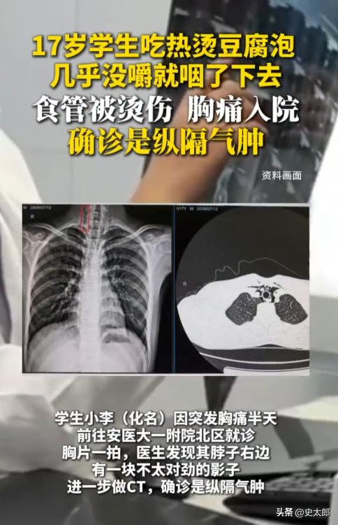 万万没想到！安徽，一名 17 岁学生吃热豆腐泡，因为入嘴嫌热，他直接就给吞下去，