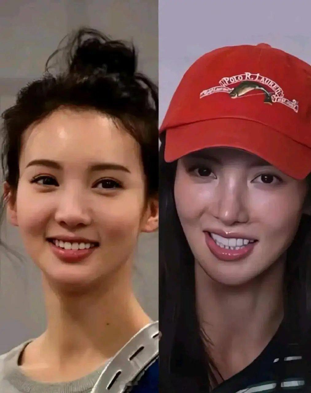 金晨没整前婴儿肥挺漂亮，如今脸上后遗症明显。。。 ​​​