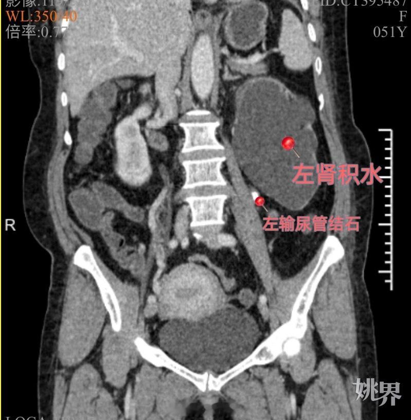 【可惜！ 可余姚女子只因一颗小石头却要切了一个肾  】在健康的世界里，我们常常忽