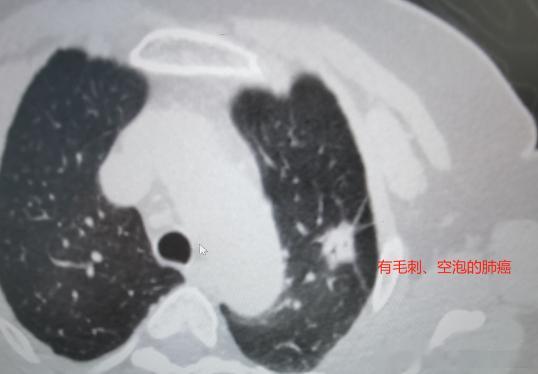 #肺结节和肺癌是什么关系#？做过胸部CT的人，大约70～80%会发现报告上显示有