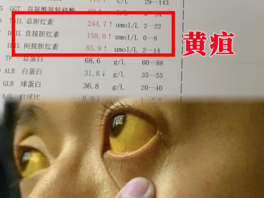胆红素升高有什么危害？医生给你讲清楚！