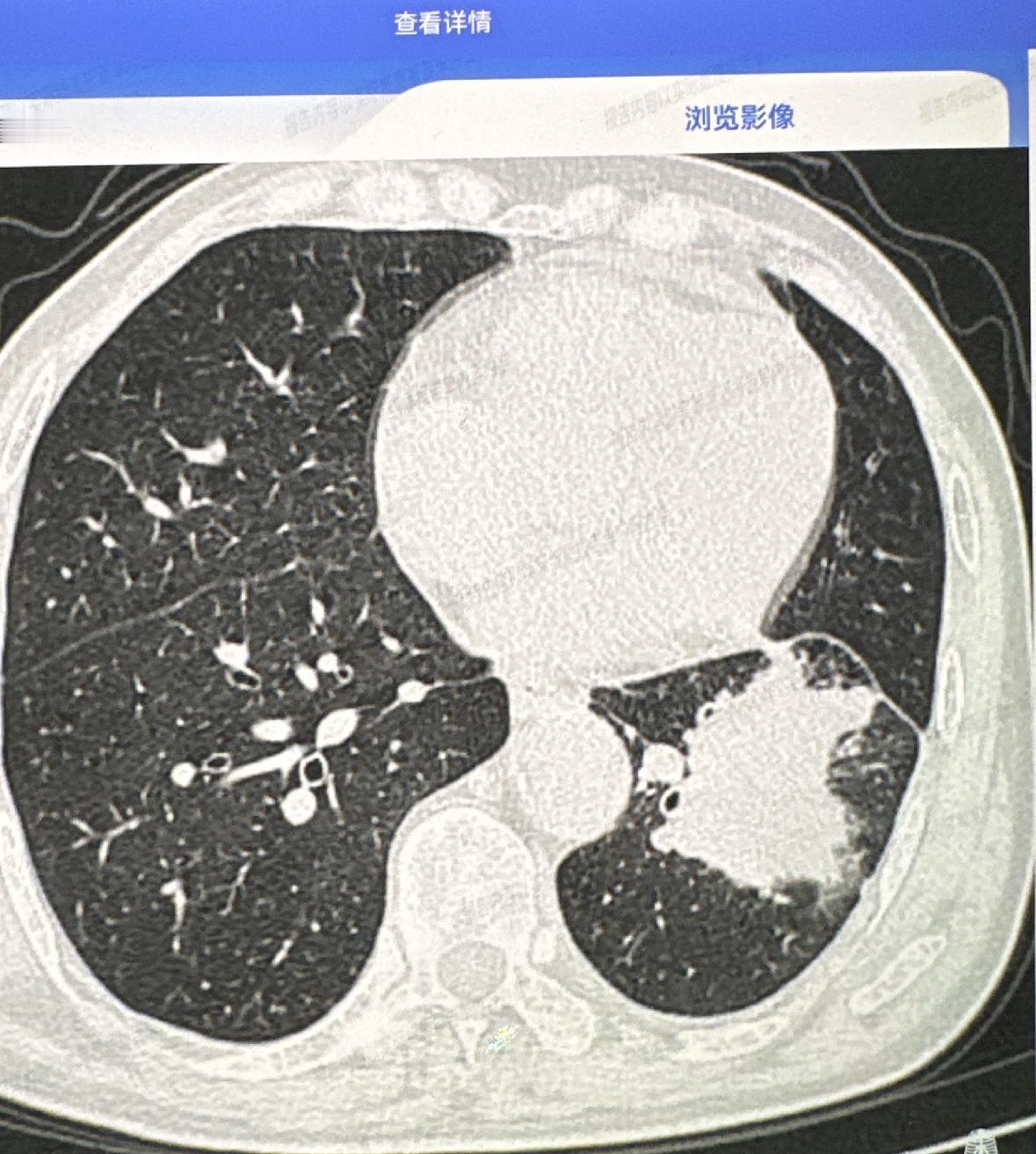 两个患者网上咨询我，肺部肿块长到了5cm才看，手术是做不了了
两个病人都挺让人惋