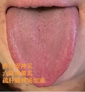 今天来看一个红舌，患者胃口差，口干口臭，喜食凉东西，吃完又容易拉肚子，平日里大便