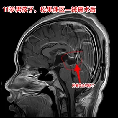 松果体区的绒毛膜癌（绒癌）很罕见。通常情况下，绝大多数的绒癌与女性怀孕...