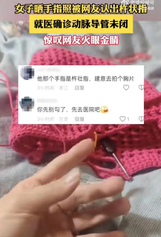 太险了！长沙女子随手晒织毛衣的手指，被网友一眼认出是杵状指，幸好发现及时去医院查