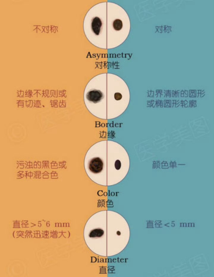 危险黑痣五大识别要点（ABCDE法则）① A不对称：良性痣左右对称，恶变痣两半形