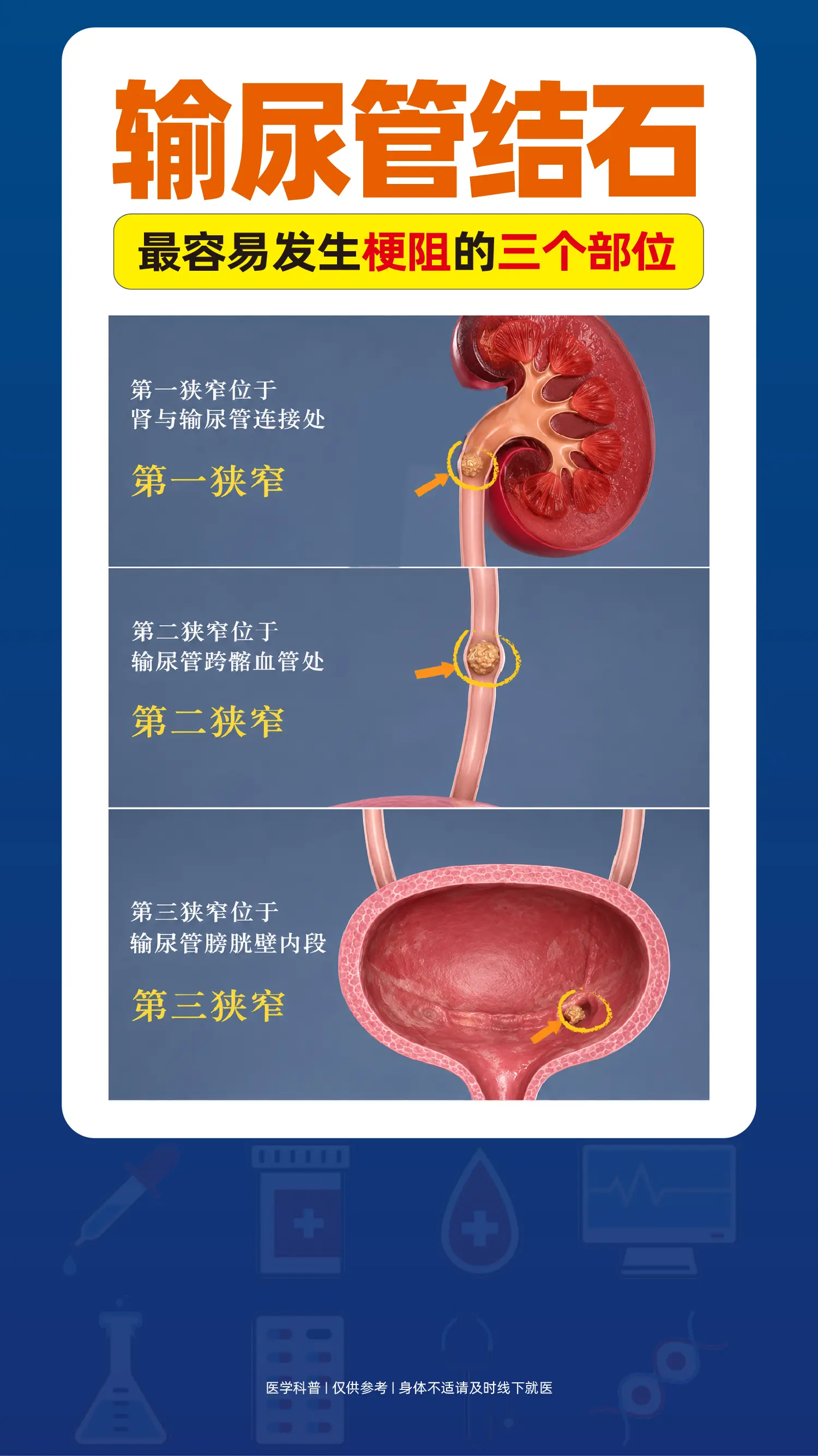 输尿管结石容易发生梗阻的三个部位。