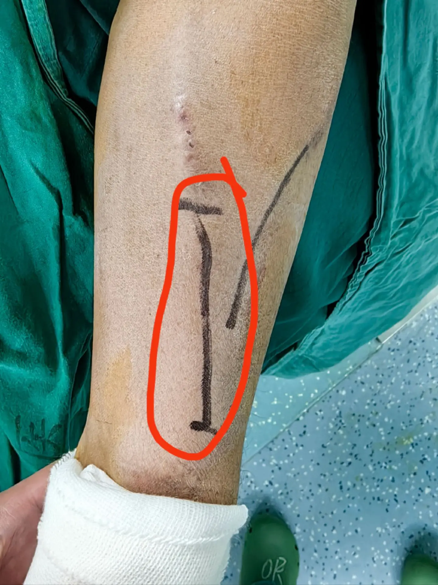 为血透患者维护生命线