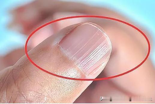 指甲竖纹是咋回事？
 
       不少中老年人发现手指甲长出竖纹，心里十分焦