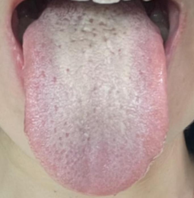 一、舌象辨证：跳出 “脾虚” 误区，认准 “肝火 + 湿热” 信号
很多人出现消